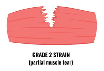 Grade 2 Strain