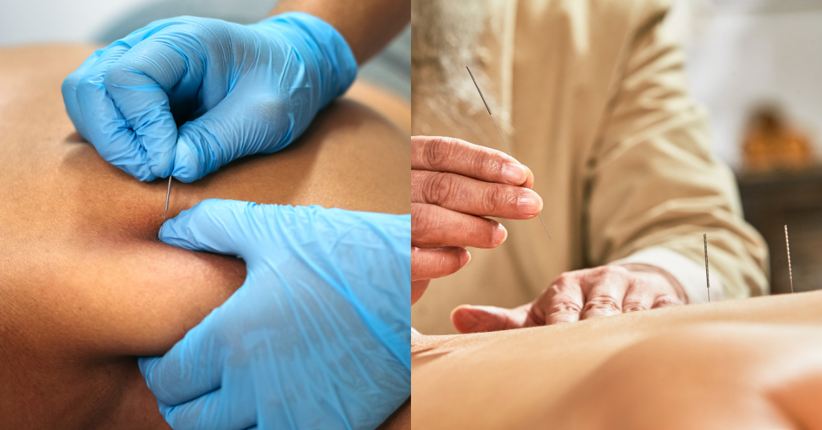 Dry Needling vs Acupuncture I Benefits and Functions