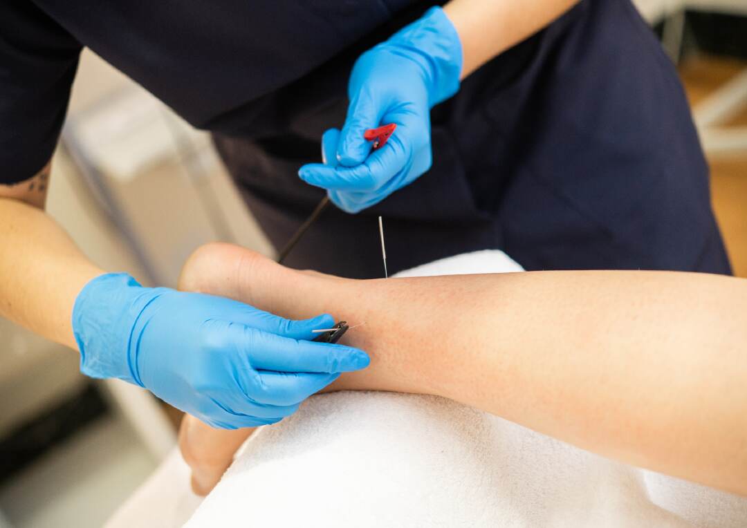 dry needling vs acupuncture