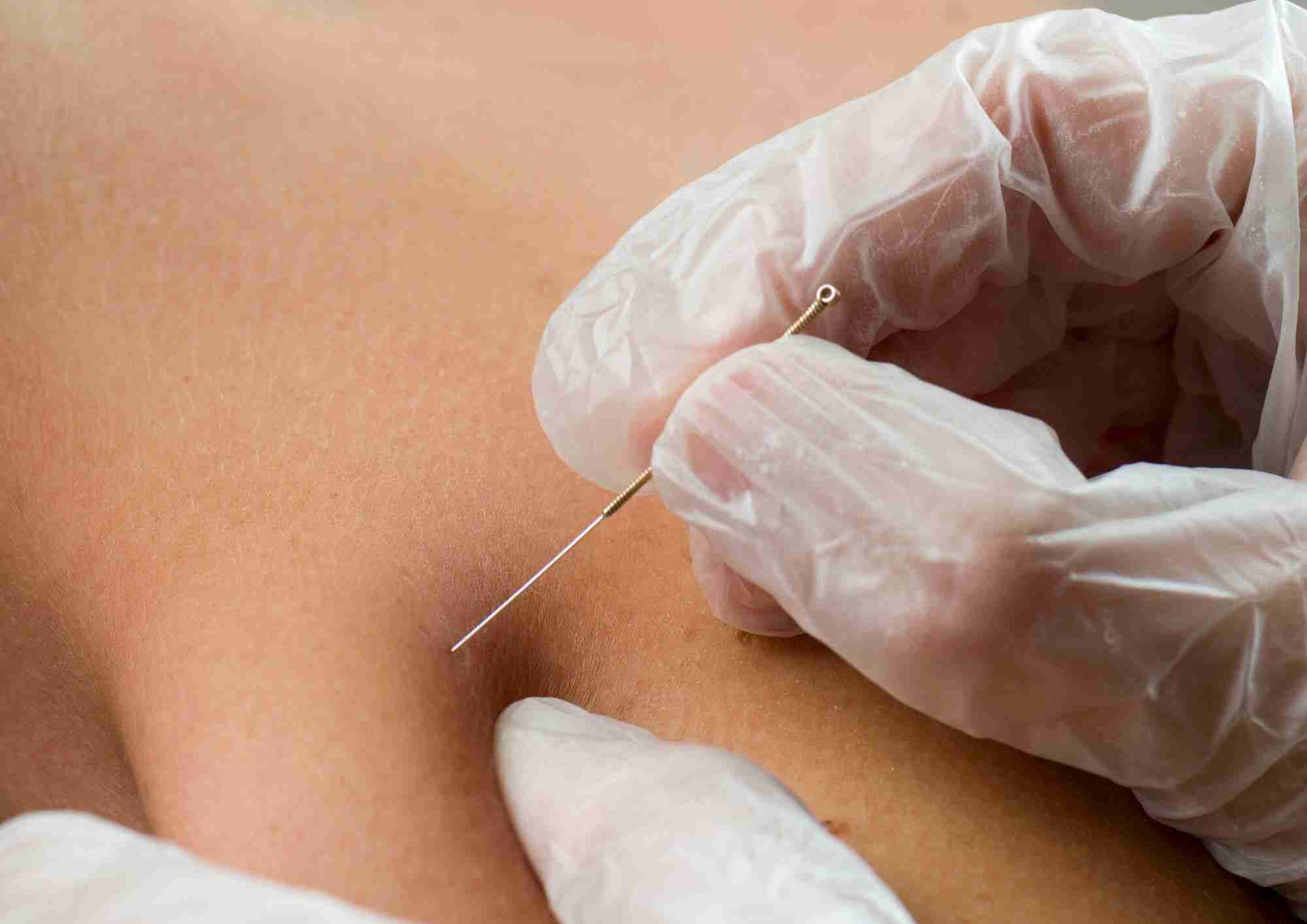 dry needling vs acupuncture